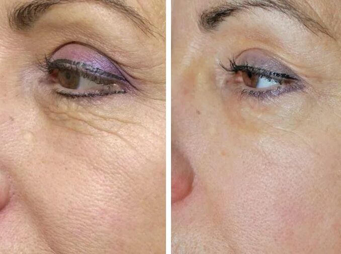 On-site laser before and after