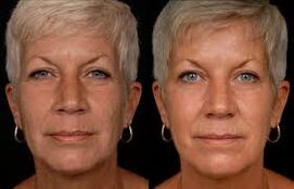 woman face before and after