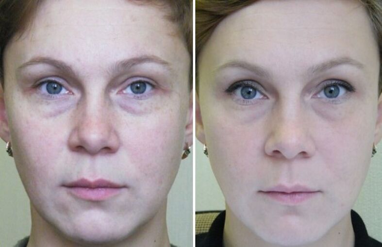 Laser rejuvenation before and after photos